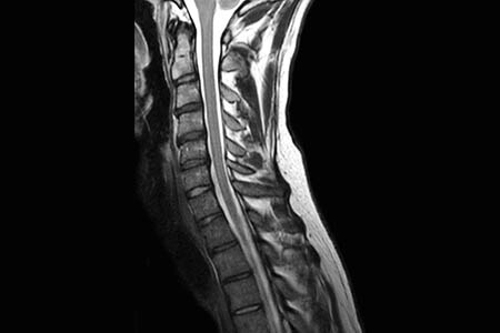 fat free spine