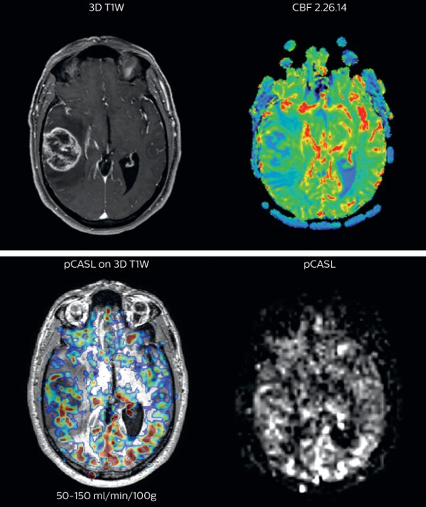 UVM case 3 Cerebral blood flow 