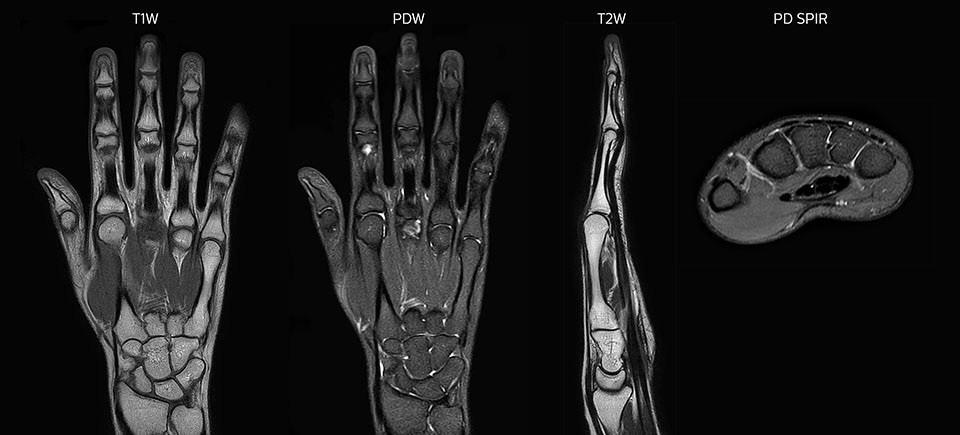 MRI of hand and wrist with large FOV