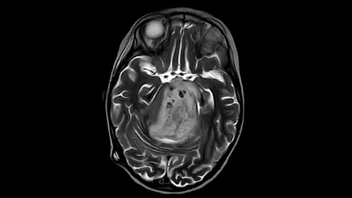 MRI of pediatric brainstem glioma