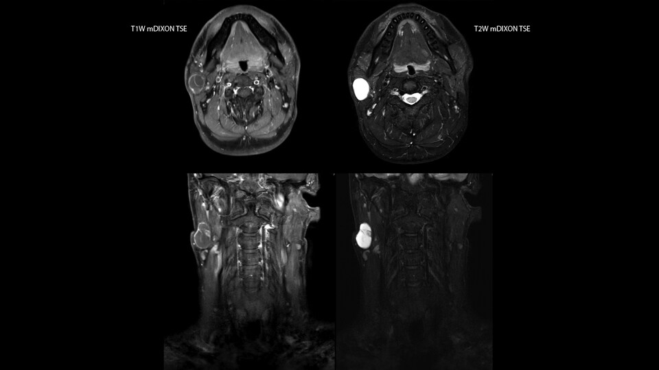 MRI of cystic lesion in soft tissue neck